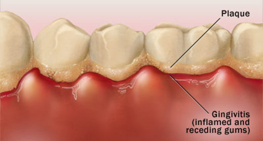 dental plaque