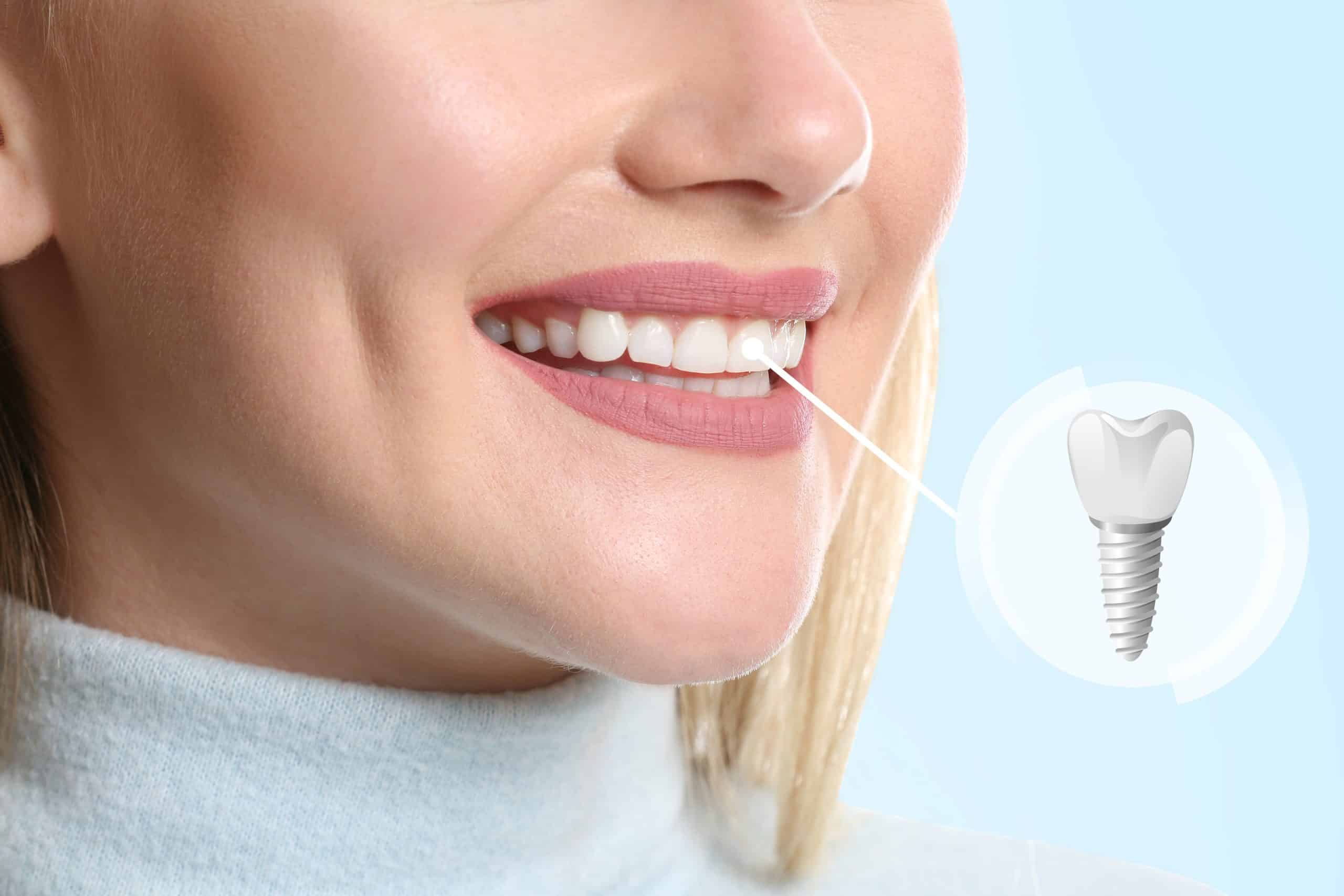 Smiling woman with dental implant illustration overlay, highlighting All-On-4 ideal candidate with bright, healthy teeth.